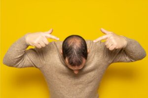 Alopecia-Areata